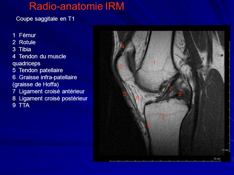 Radio-anatomie IRM Coupe saggitale en T1 1 Fémur 2 Rotule 3 Tibia