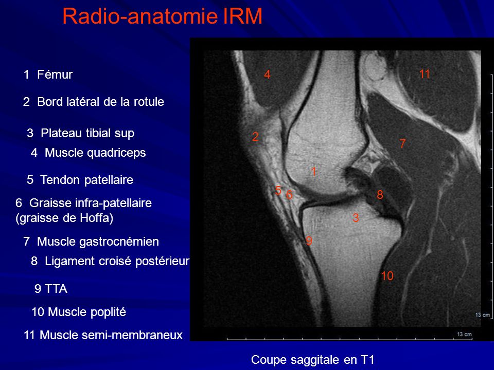 Radio-anatomie IRM 1 Fémur Bord latéral de la rotule