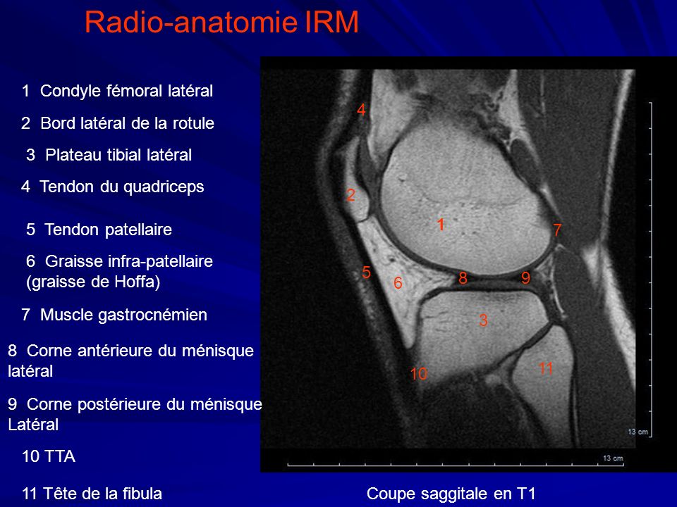 Radio-anatomie IRM 1 Condyle fémoral latéral 4