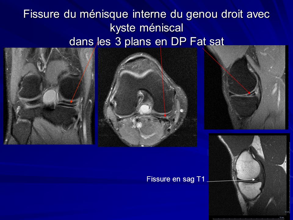 Fissure du ménisque interne du genou droit avec kyste méniscal dans les 3 plans en DP Fat sat