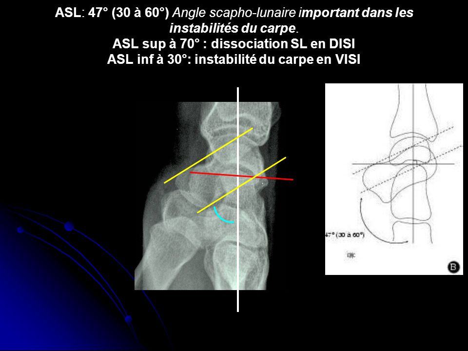ASL: 47° (30 à 60°) Angle scapho-lunaire important dans les instabilités du carpe.