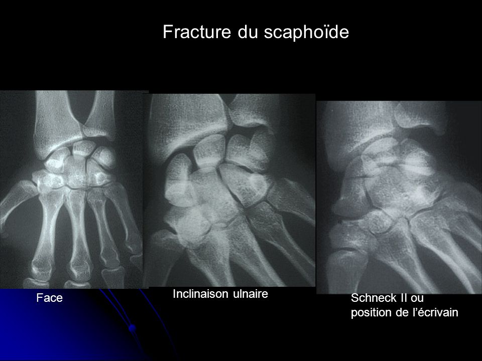 Fracture du scaphoïde Inclinaison ulnaire Face Schneck II ou