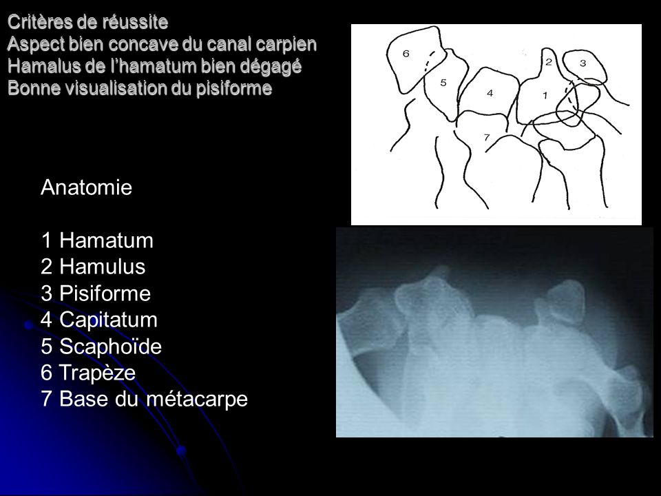 Anatomie 1 Hamatum 2 Hamulus 3 Pisiforme 4 Capitatum 5 Scaphoïde