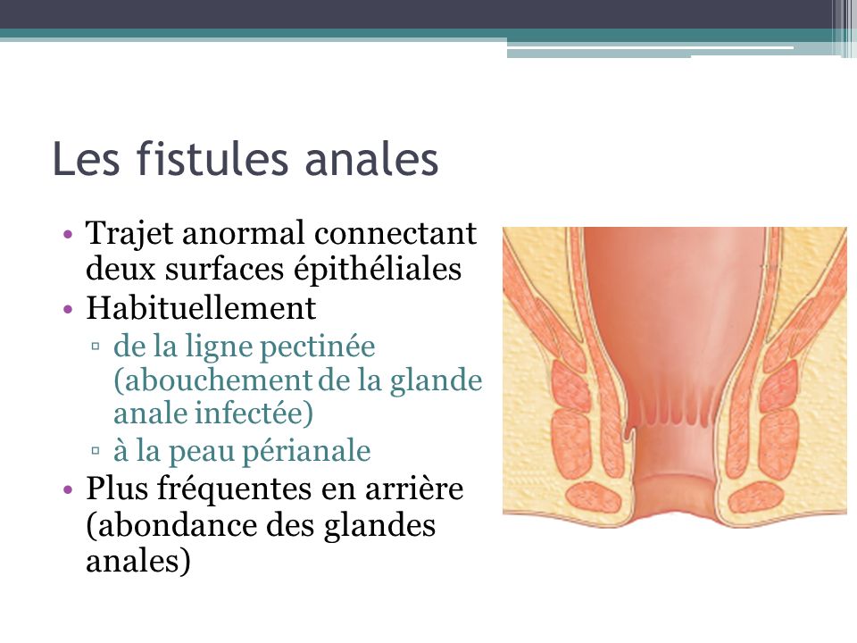 Les fistules anales Trajet anormal connectant deux surfaces épithéliales. Habituellement.