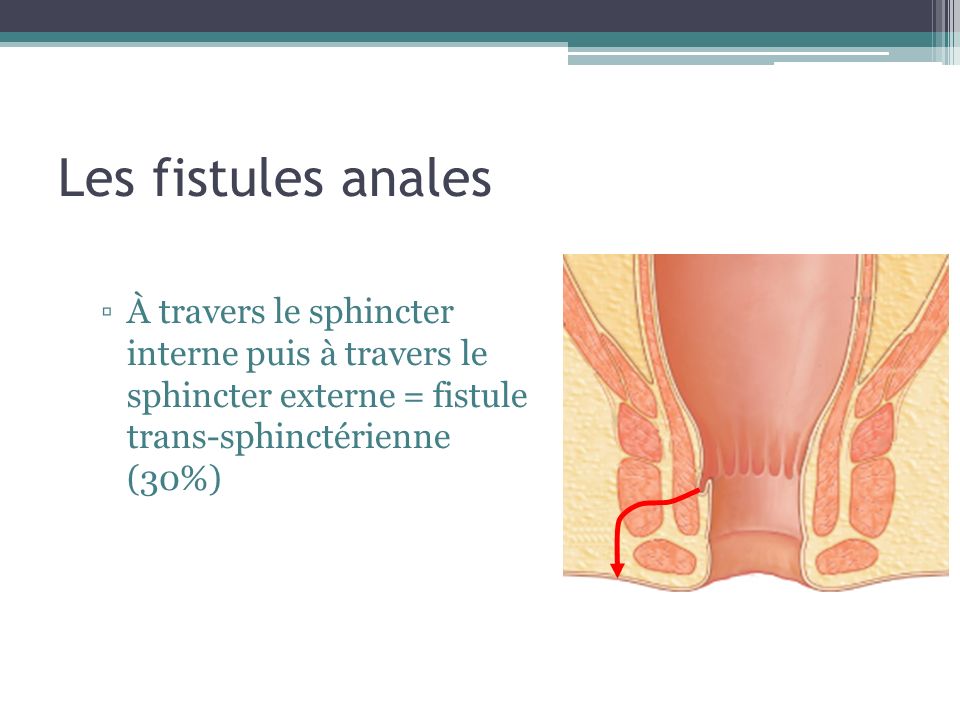 Les fistules anales À travers le sphincter interne puis à travers le sphincter externe = fistule trans-sphinctérienne (30%)