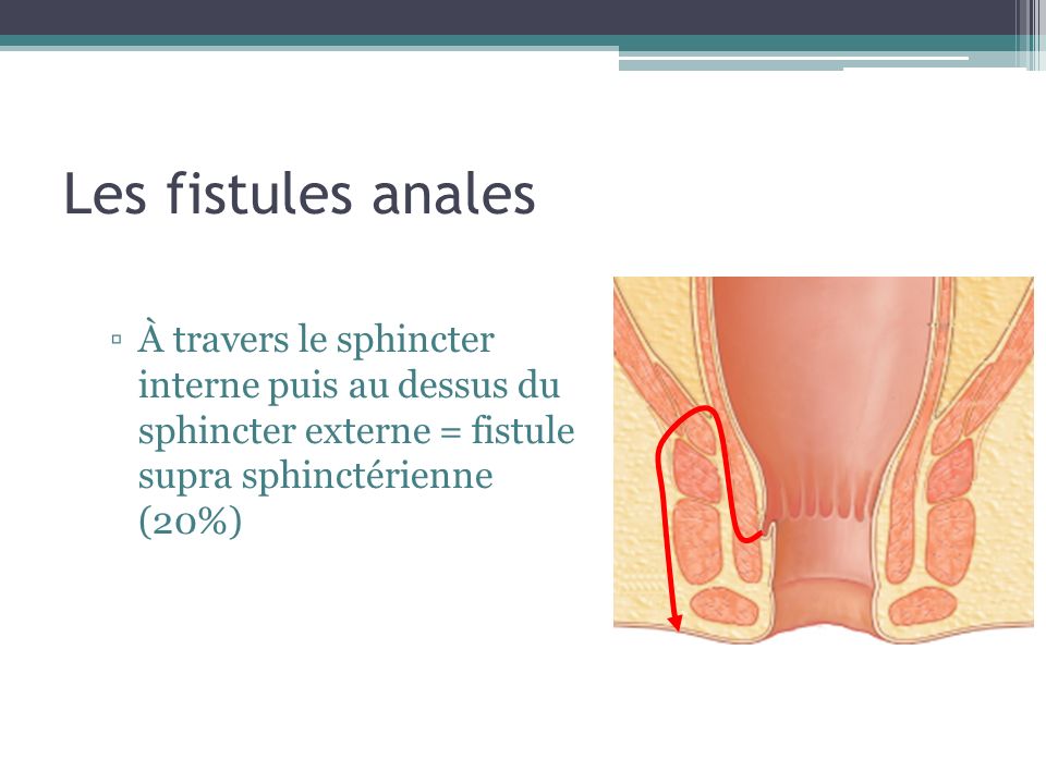 Les fistules anales À travers le sphincter interne puis au dessus du sphincter externe = fistule supra sphinctérienne (20%)