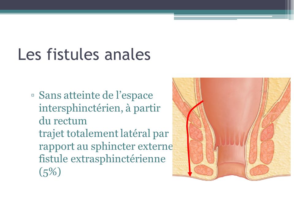 Les fistules anales