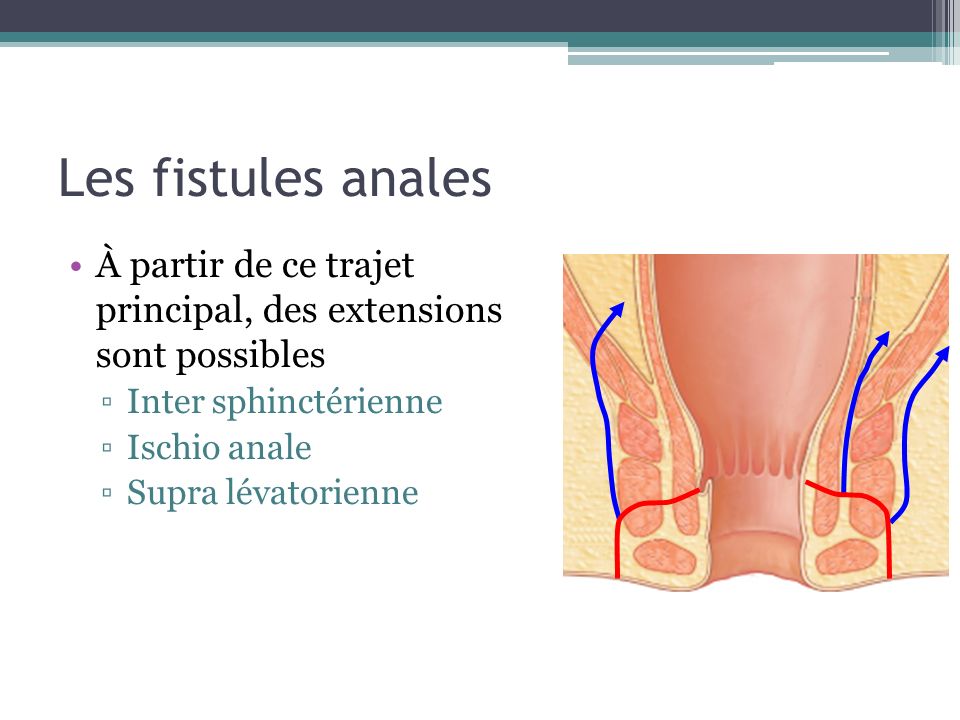 Les fistules anales À partir de ce trajet principal, des extensions sont possibles. Inter sphinctérienne.