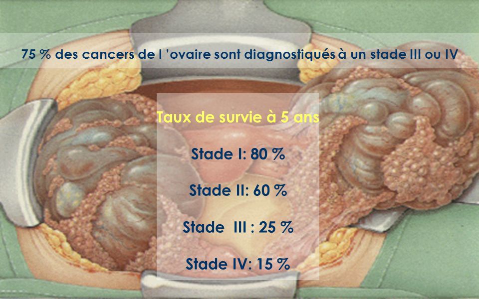75 % des cancers de l ’ovaire sont diagnostiqués à un stade III ou IV