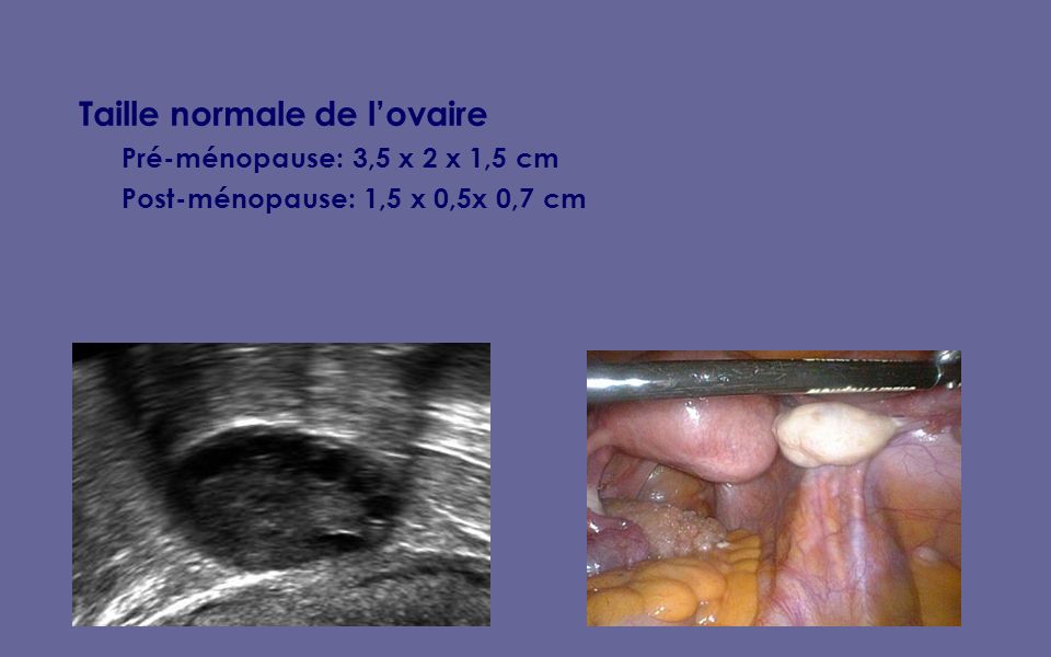 Taille normale de l’ovaire