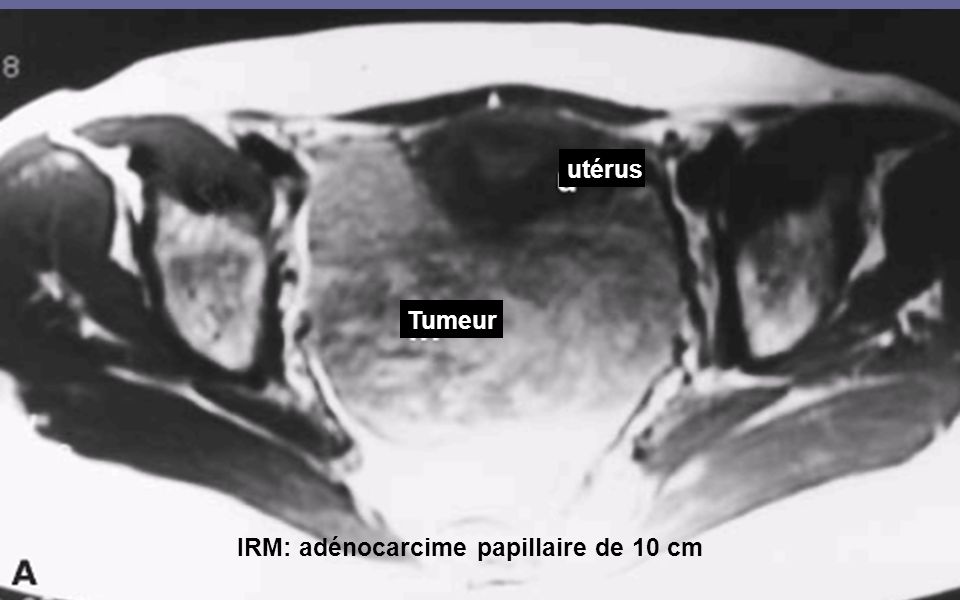 utérus Tumeur IRM: adénocarcime papillaire de 10 cm