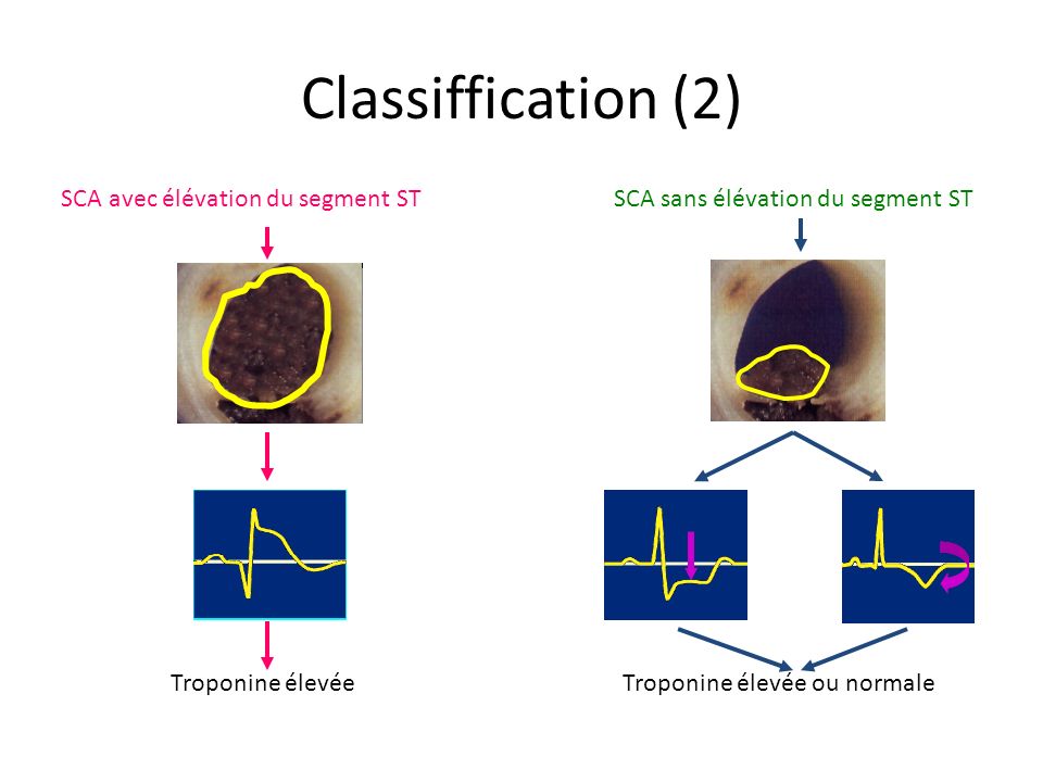 Classiffication (2) SCA avec élévation du segment ST