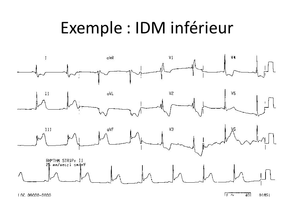 Exemple : IDM inférieur