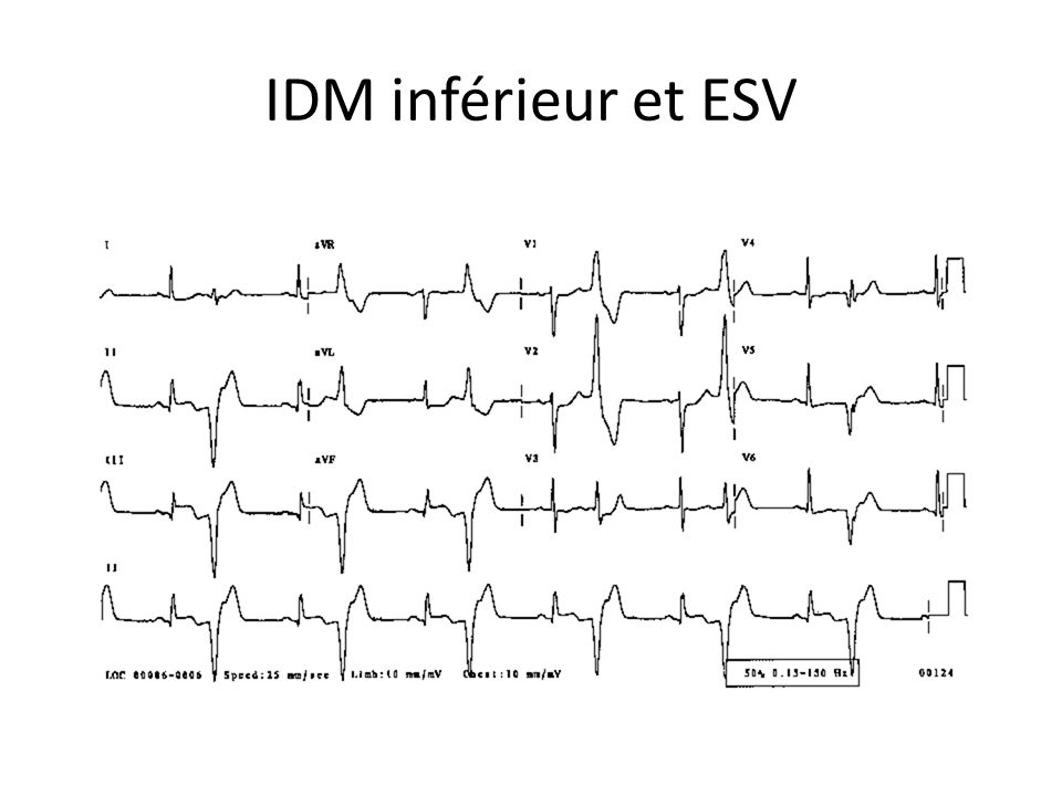 IDM inférieur et ESV