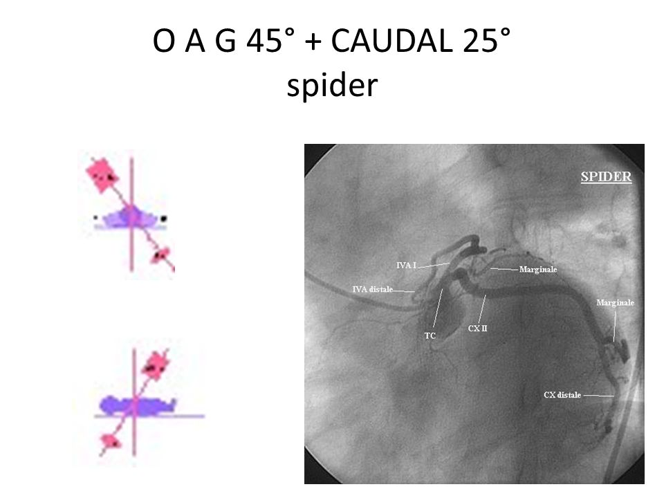 O A G 45° + CAUDAL 25° spider