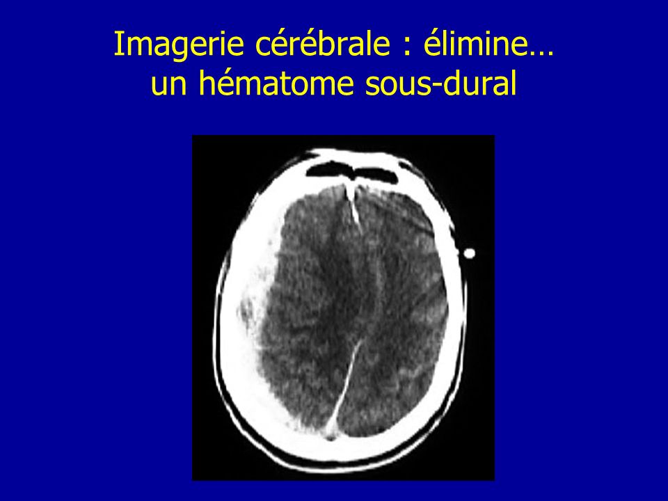 Imagerie cérébrale : élimine… un hématome sous-dural