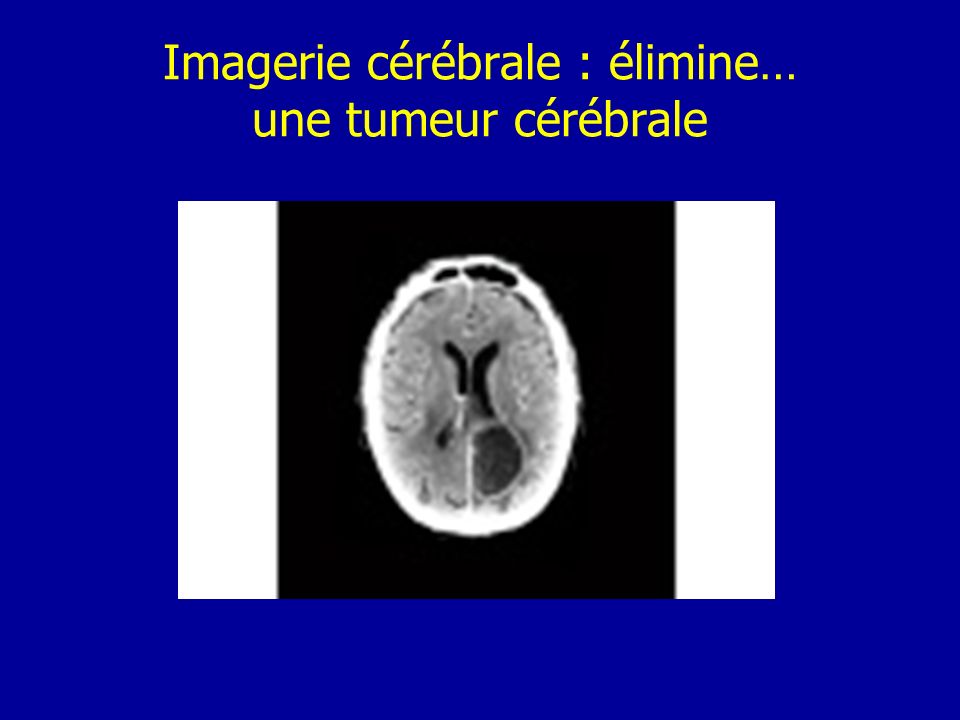 Imagerie cérébrale : élimine… une tumeur cérébrale