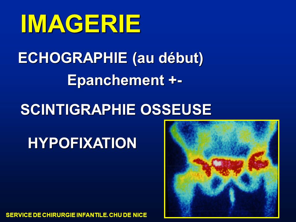 IMAGERIE ECHOGRAPHIE (au début) Epanchement +- SCINTIGRAPHIE OSSEUSE