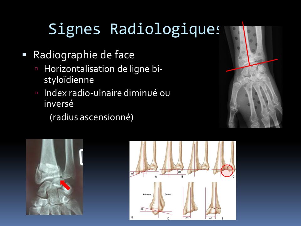 Signes Radiologiques Radiographie de face