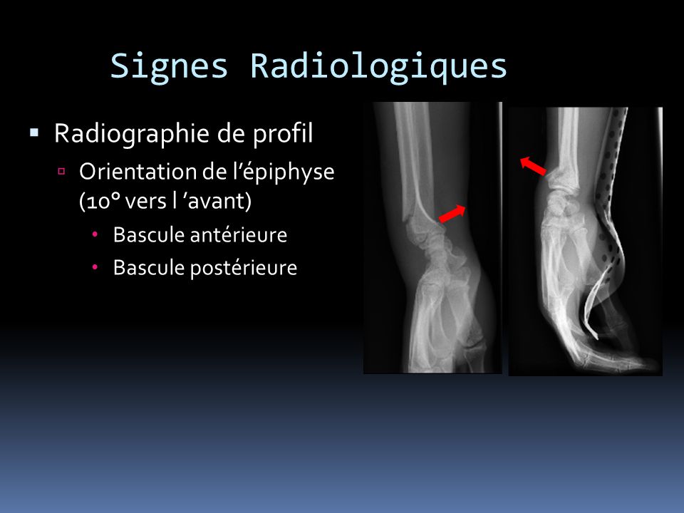Signes Radiologiques Radiographie de profil