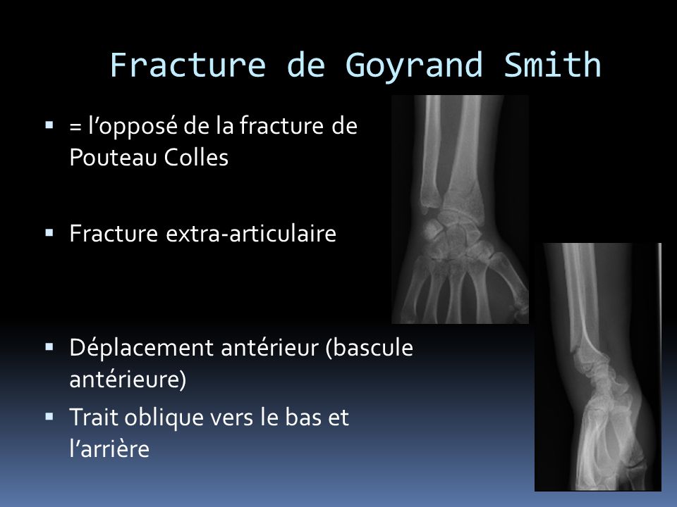 Fracture de Goyrand Smith