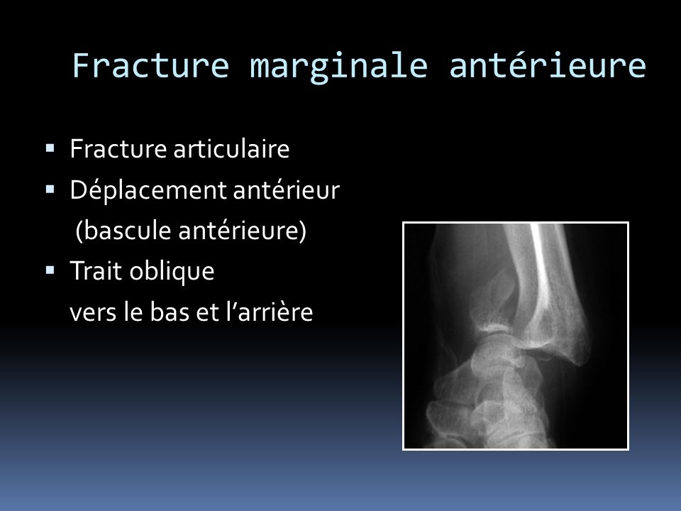 Fracture marginale antérieure