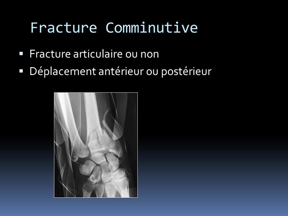Fracture Comminutive Fracture articulaire ou non