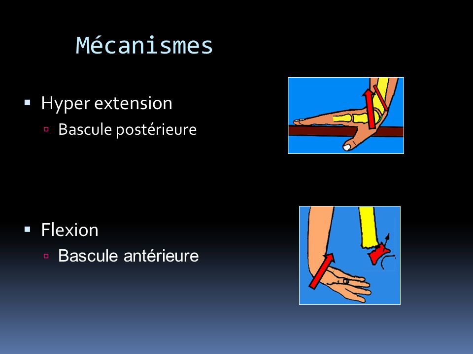 Mécanismes Hyper extension Flexion Bascule postérieure