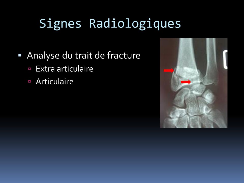 Signes Radiologiques Analyse du trait de fracture Extra articulaire