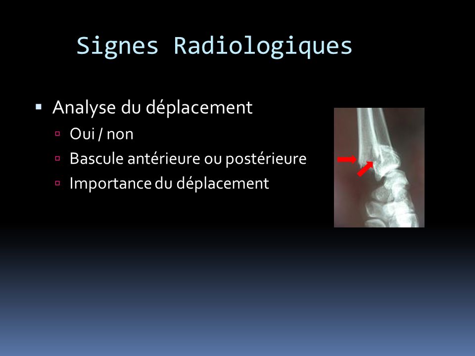 Signes Radiologiques Analyse du déplacement Oui / non