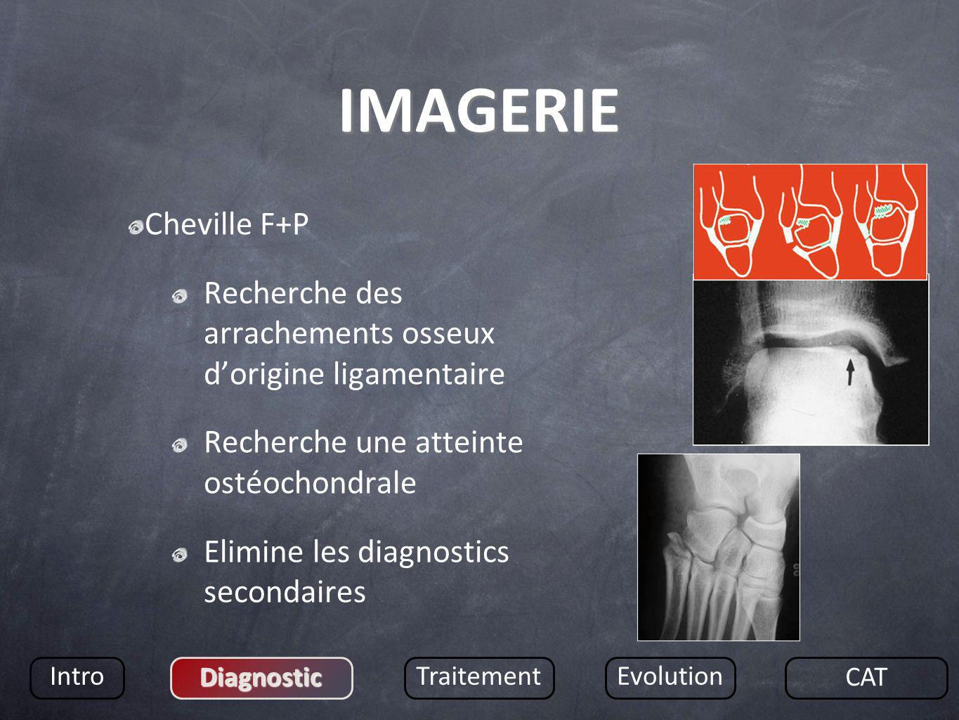 IMAGERIE Cheville F+P. Recherche des arrachements osseux d’origine ligamentaire. Recherche une atteinte ostéochondrale.