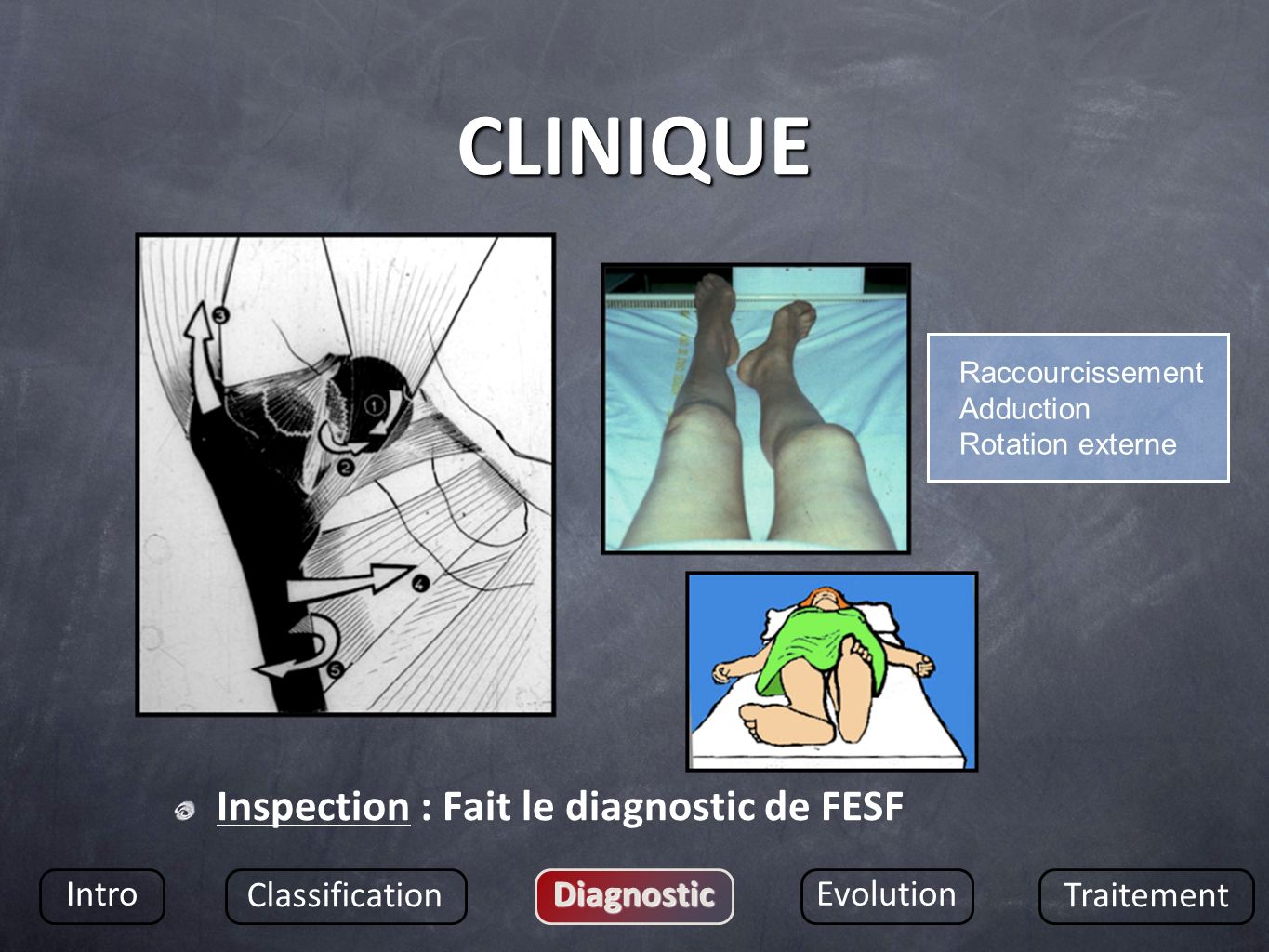 CLINIQUE Inspection : Fait le diagnostic de FESF Intro Classification