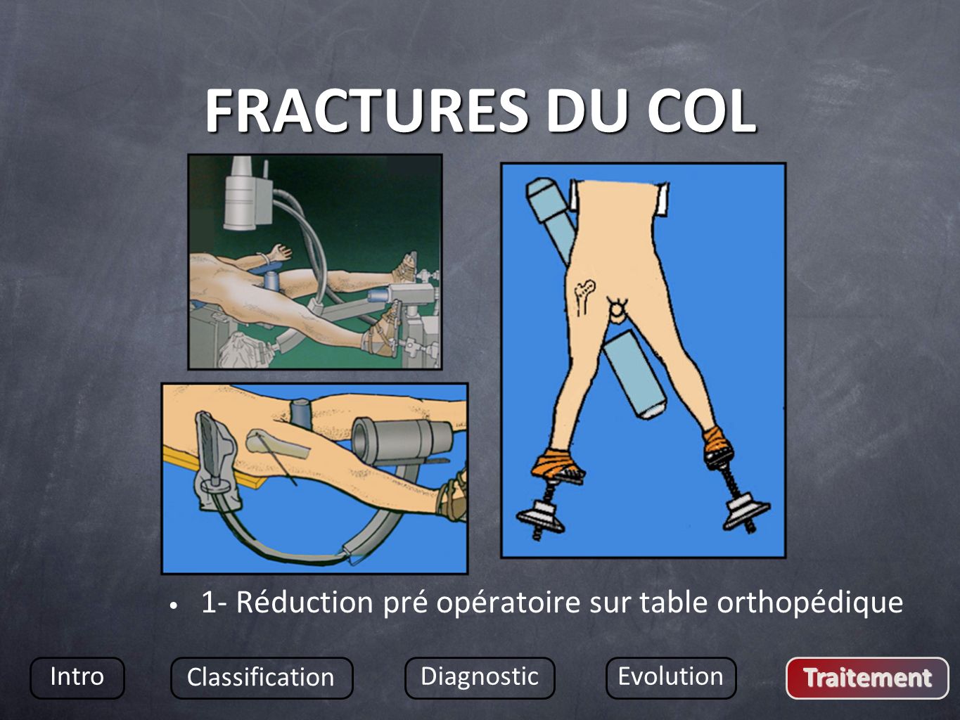 FRACTURES DU COL 1- Réduction pré opératoire sur table orthopédique