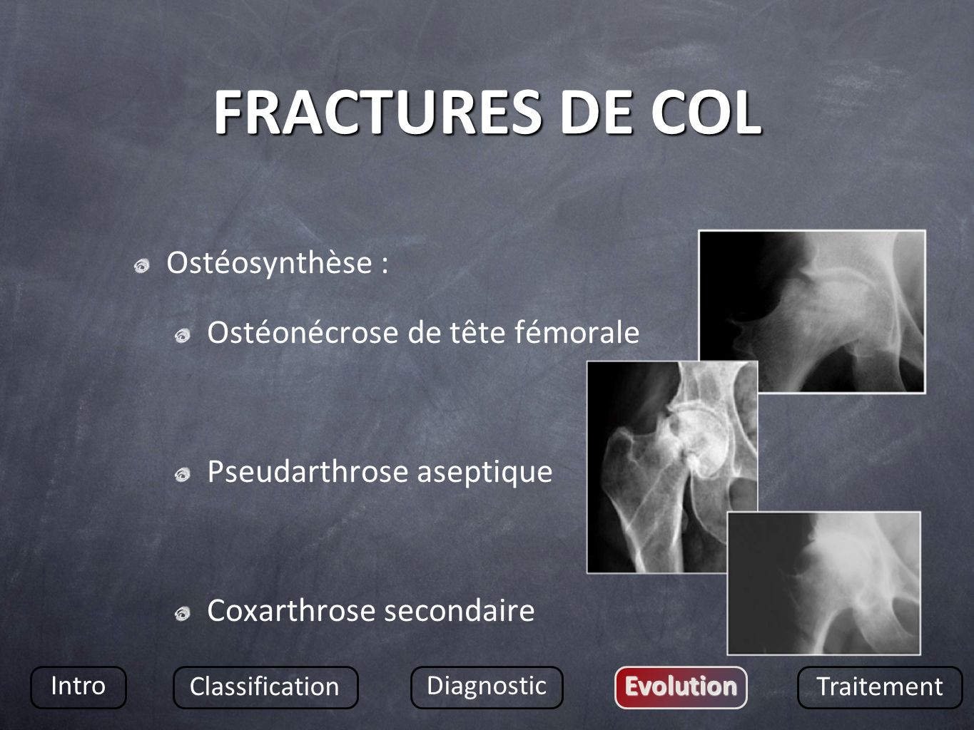 FRACTURES DE COL Ostéosynthèse : Ostéonécrose de tête fémorale
