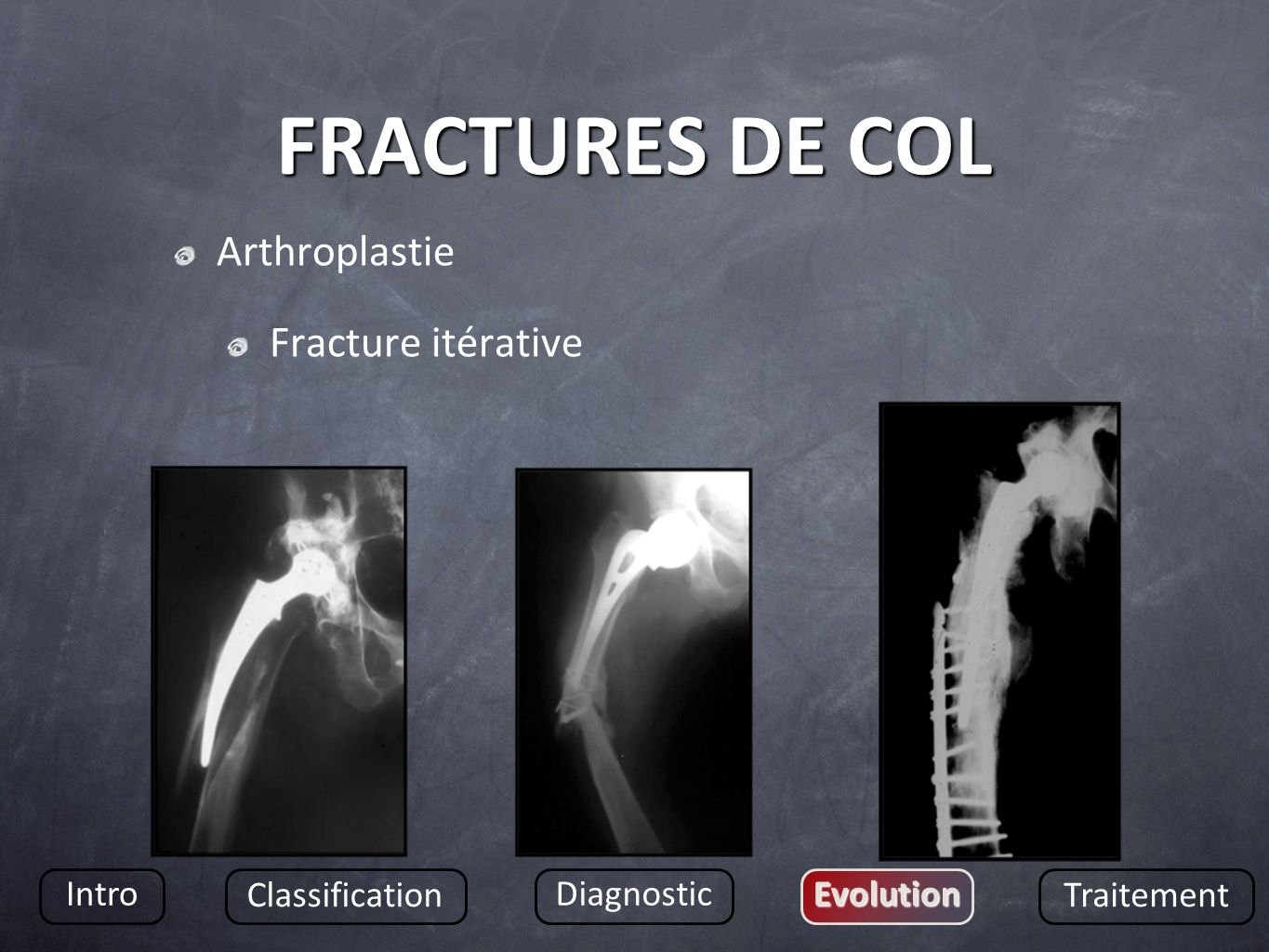 FRACTURES DE COL Arthroplastie Fracture itérative Intro Classification