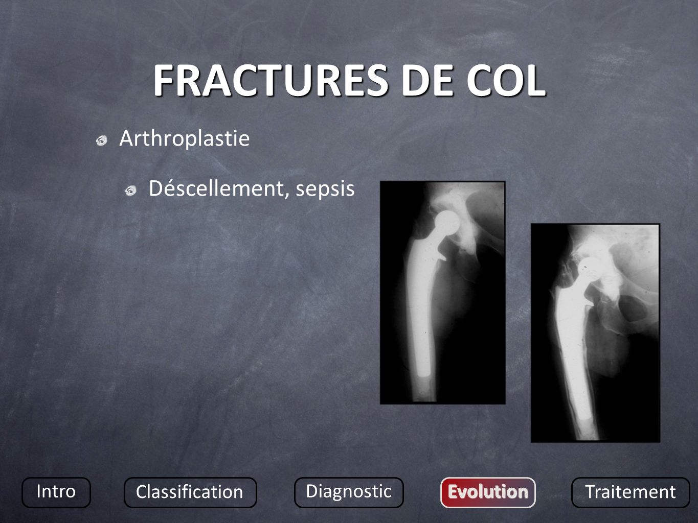 FRACTURES DE COL Arthroplastie Déscellement, sepsis Intro