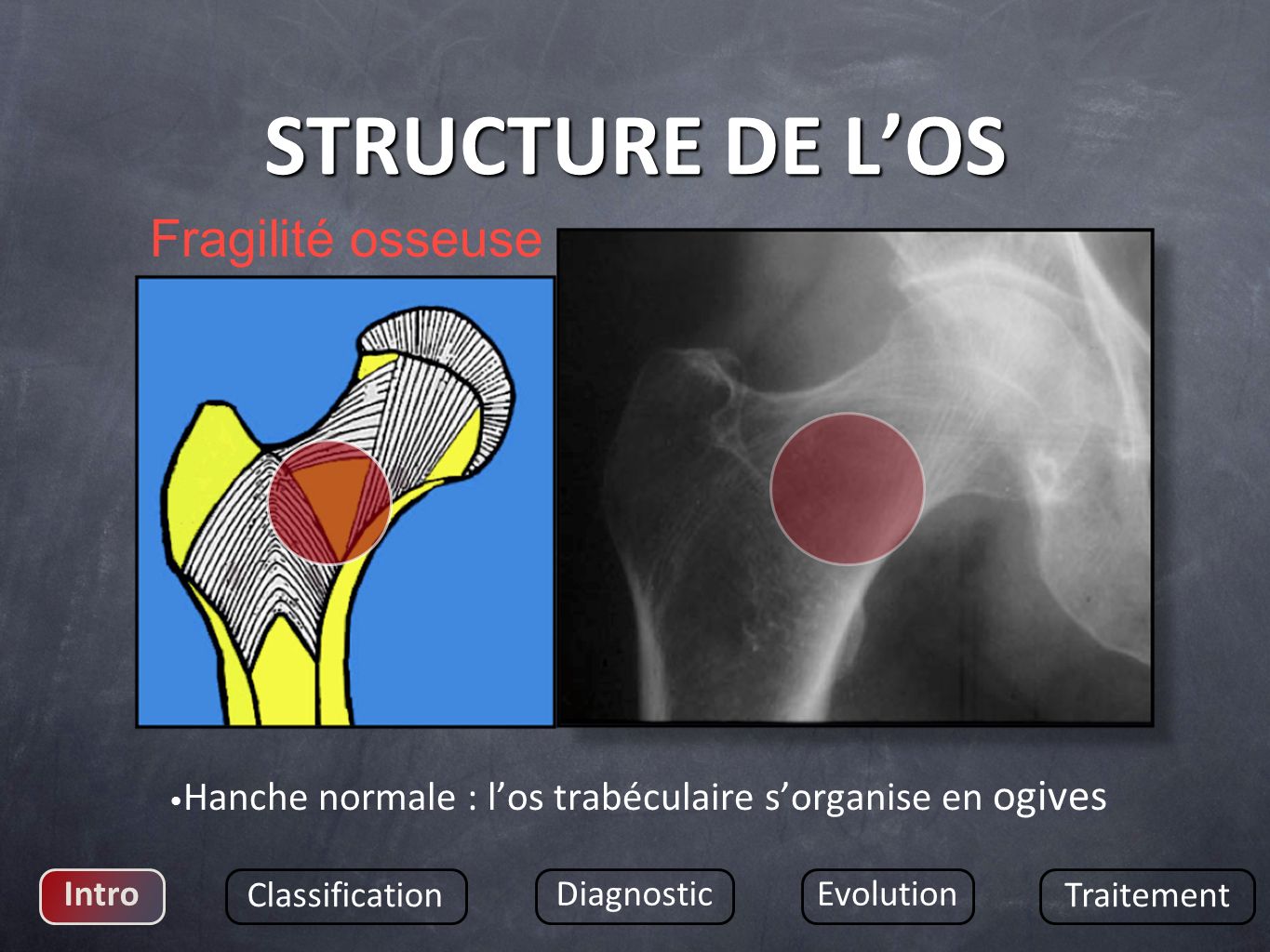 STRUCTURE DE L’OS Fragilité osseuse