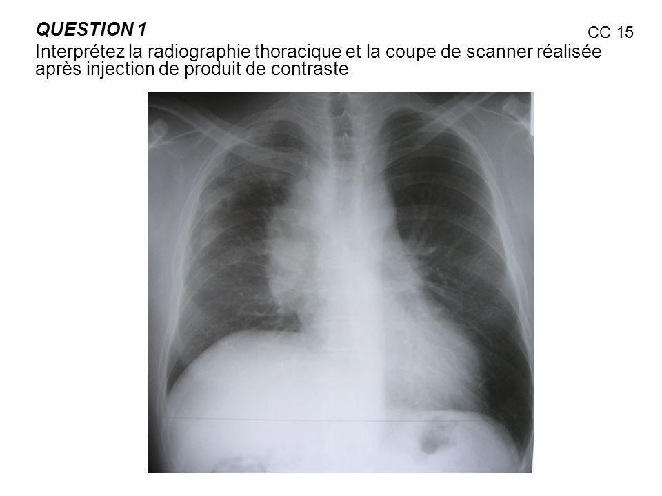 QUESTION 1 Interprétez la radiographie thoracique et la coupe de scanner réalisée après injection de produit de contraste.