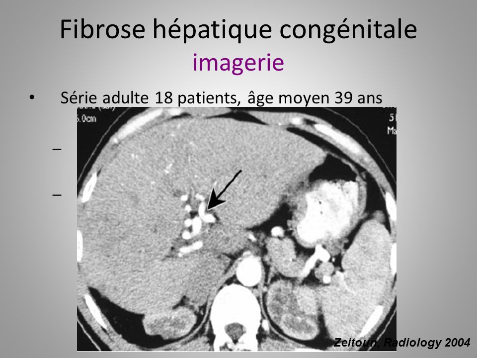 Fibrose hépatique congénitale imagerie