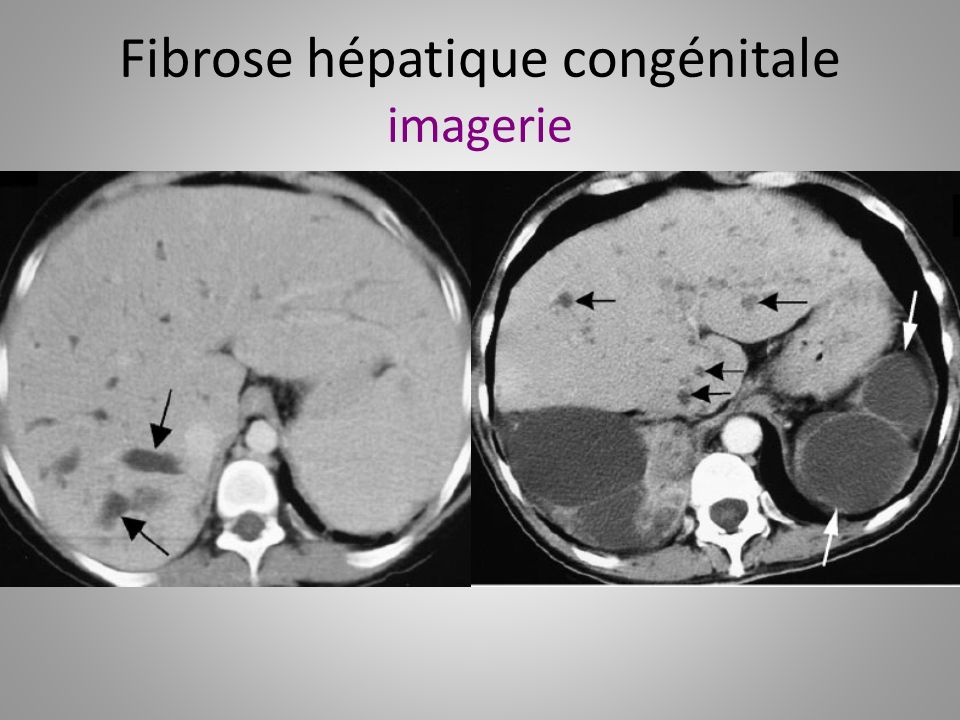 Fibrose hépatique congénitale imagerie