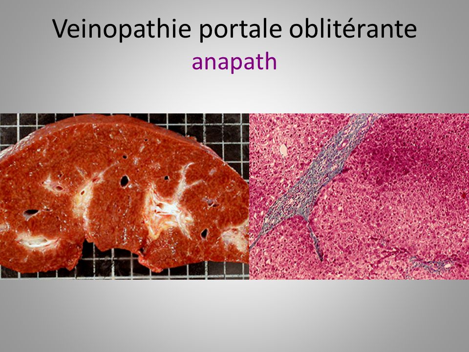 Veinopathie portale oblitérante anapath