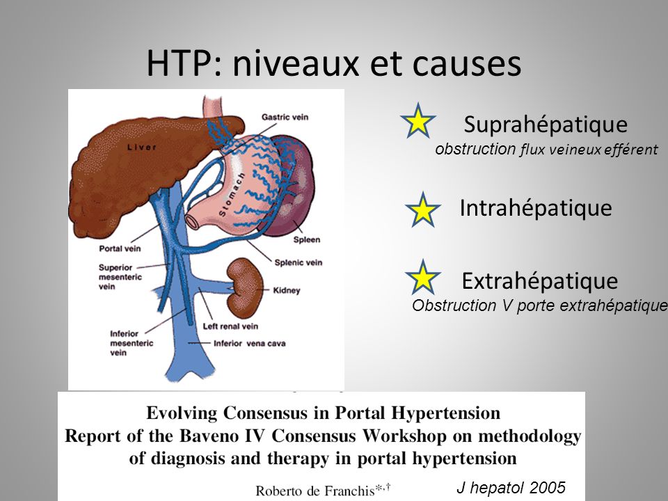 HTP: niveaux et causes Suprahépatique Intrahépatique Extrahépatique