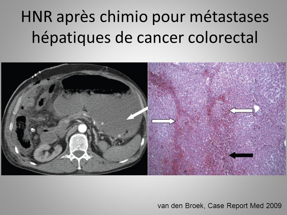 HNR après chimio pour métastases hépatiques de cancer colorectal