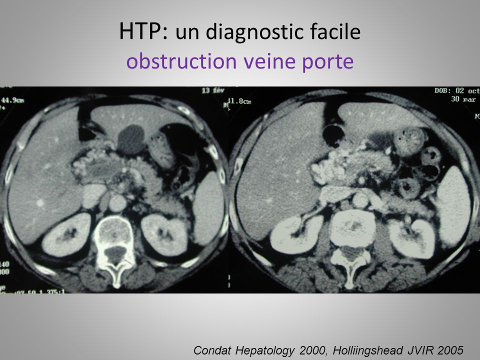 HTP: un diagnostic facile obstruction veine porte