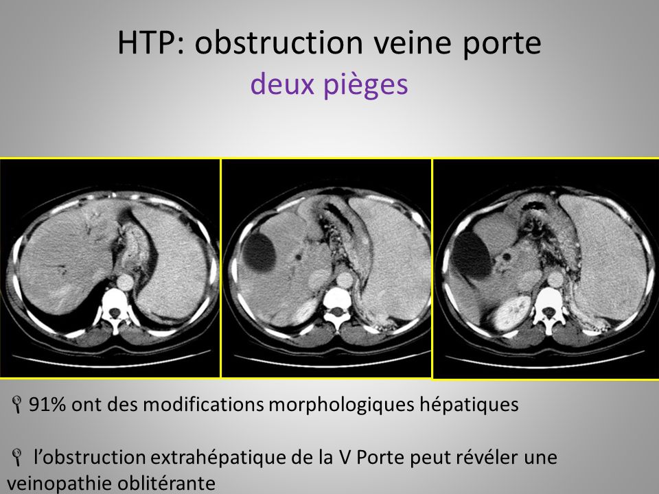 HTP: obstruction veine porte deux pièges