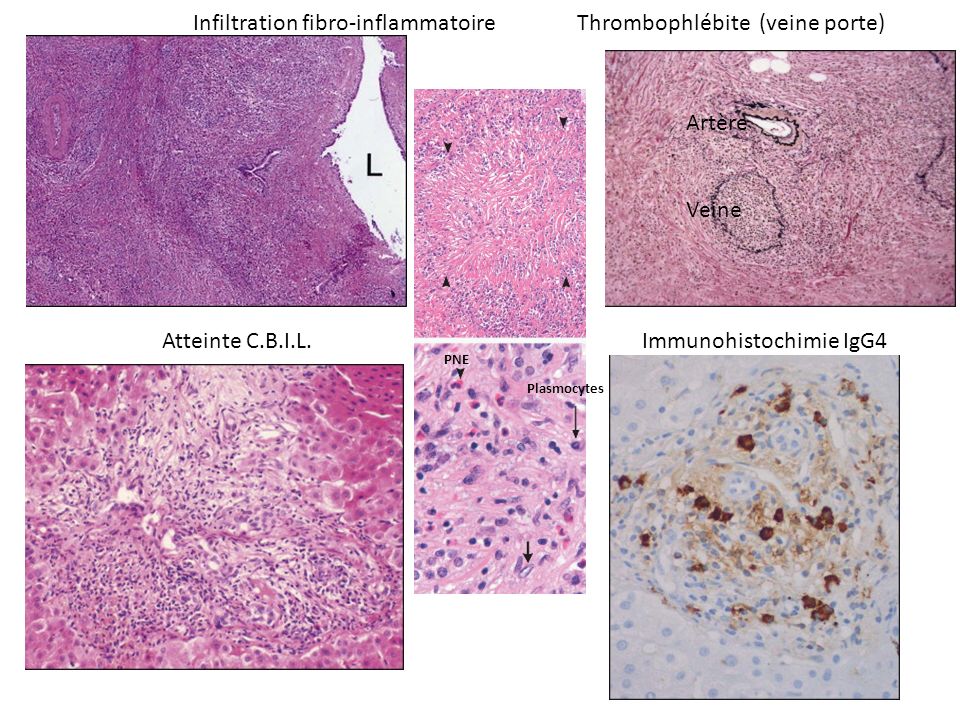Infiltration fibro-inflammatoire Thrombophlébite (veine porte)