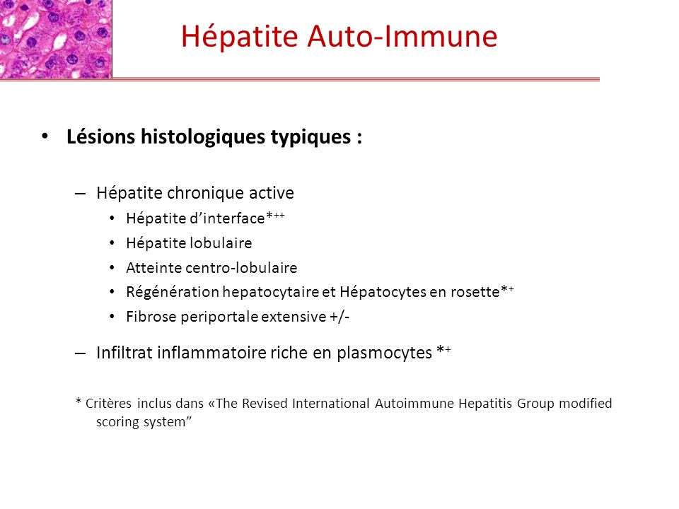 Hépatite Auto-Immune Lésions histologiques typiques :