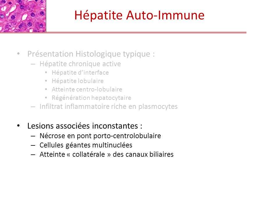 Hépatite Auto-Immune Présentation Histologique typique :