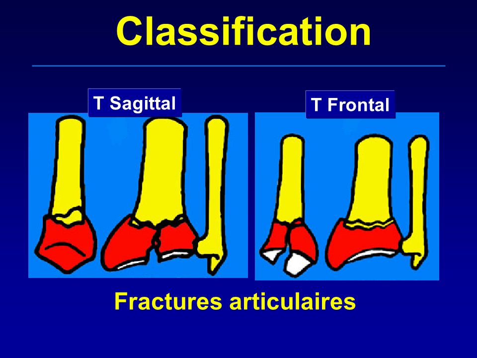 Classification T Sagittal T Frontal Fractures articulaires