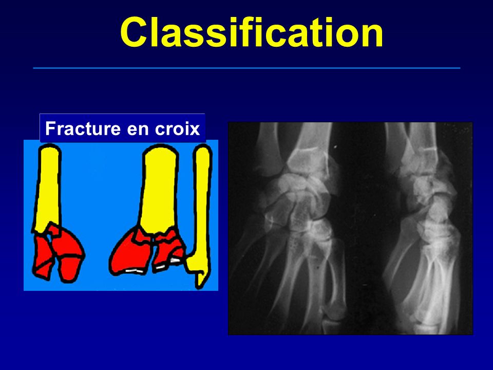 Classification Fracture en croix